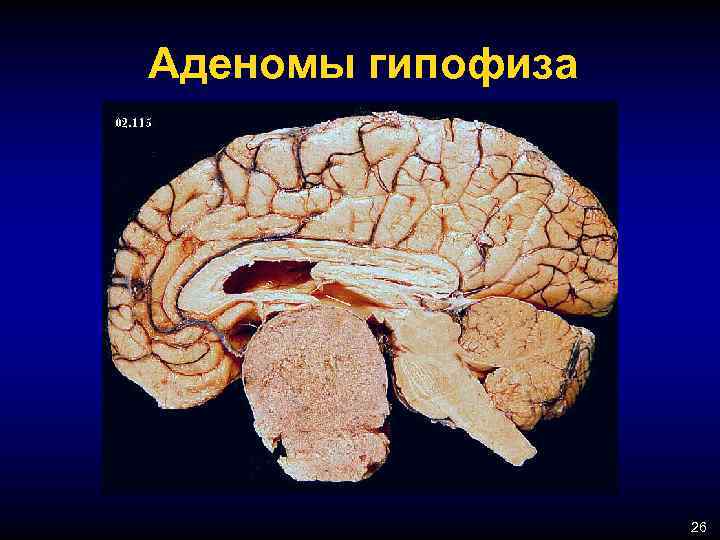 Аденомы гипофиза 26 