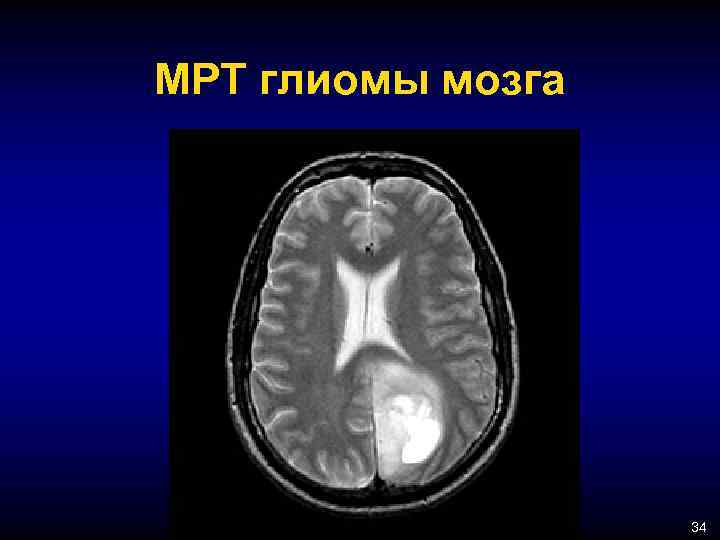 Глиома степени злокачественности