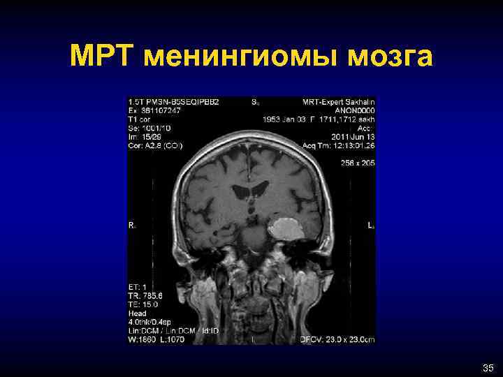 МРТ менингиомы мозга 35 