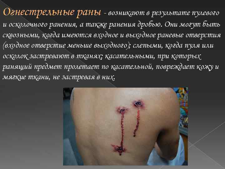 Огнестрельные раны - возникают в результате пулевого и осколочного ранения, а также ранения дробью.