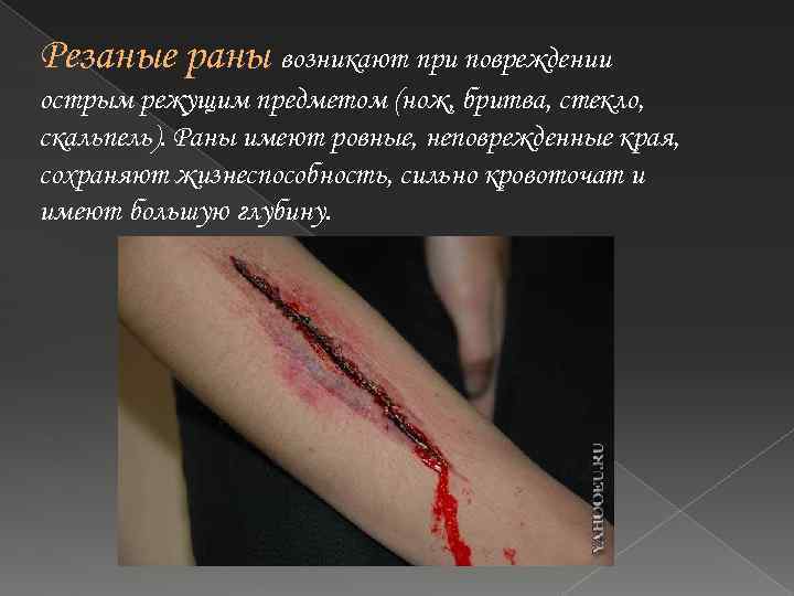 Резаные раны возникают при повреждении острым режущим предметом (нож, бритва, стекло, скальпель). Раны имеют