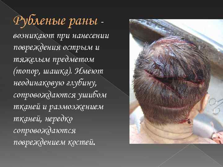Рубленые раны возникают при нанесении повреждения острым и тяжелым предметом (топор, шашка). Имеют неодинаковую