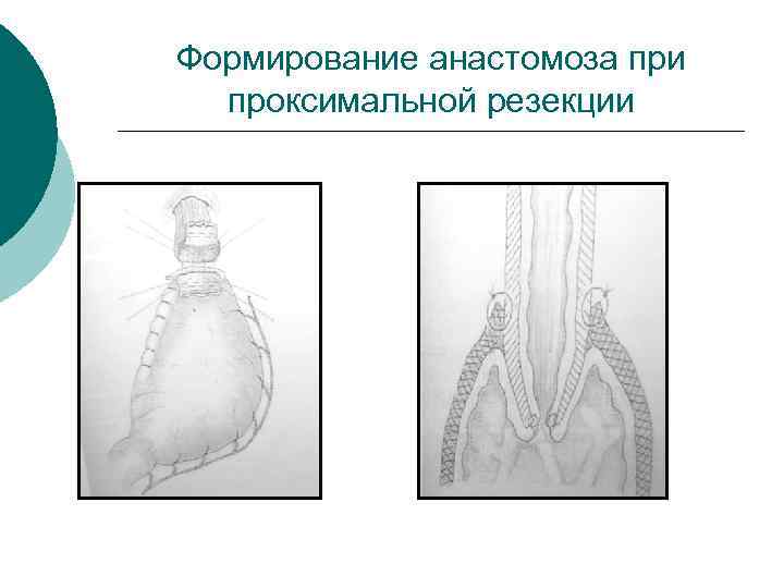 Формирование анастомоза при проксимальной резекции 