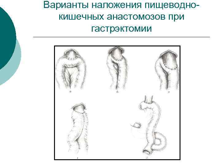 Варианты наложения пищеводнокишечных анастомозов при гастрэктомии 