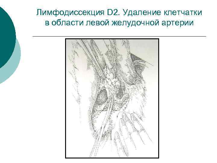 Лимфодиссекция D 2. Удаление клетчатки в области левой желудочной артерии 