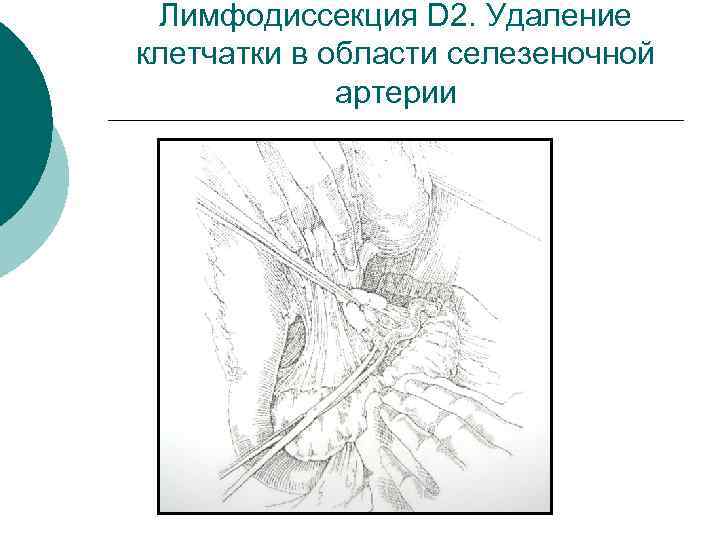 Лимфодиссекция D 2. Удаление клетчатки в области селезеночной артерии 