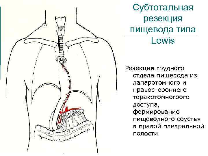 Субтотальная резекция пищевода типа Lewis Резекция грудного отдела пищевода из лапаротомного и правостороннего торакотомногоого