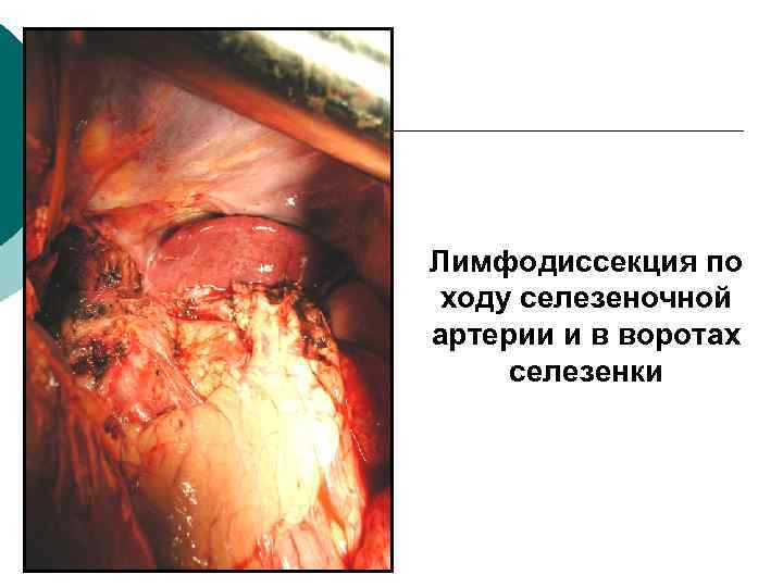 Лимфодиссекция по ходу селезеночной артерии и в воротах селезенки 