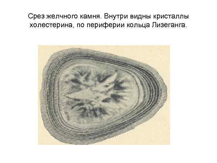 Срез желчного камня. Внутри видны кристаллы холестерина, по периферии кольца Лизеганга. 