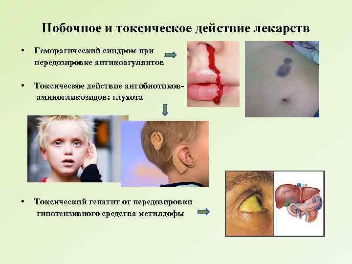 Побочное и токсическое действие лекарств • Геморагический синдром при передозировке антикоагулянтов • Токсическое действие