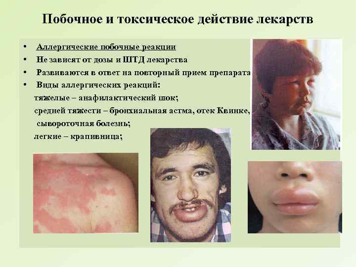 Побочное и токсическое действие лекарств • • Аллергические побочные реакции Не зависят от дозы
