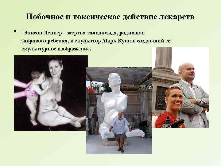 Побочное и токсическое действие лекарств • Элисон Леппер – жертва талидомида, родившая здорового ребенка,