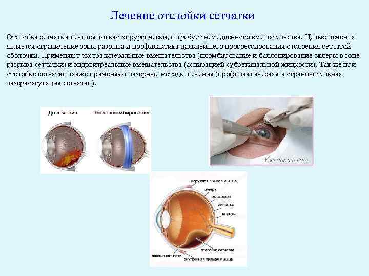 Отслоение сетчатки глаза операция