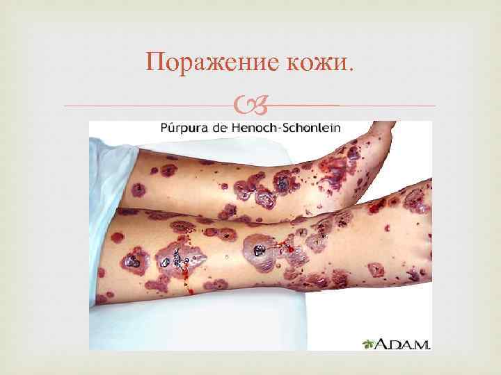 Поражение кожи. 