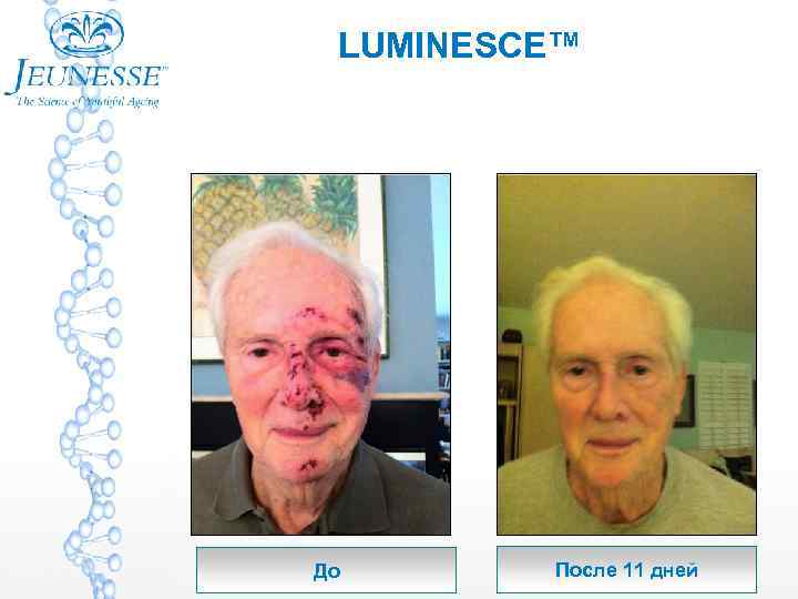 LUMINESCE™ До После 11 дней 