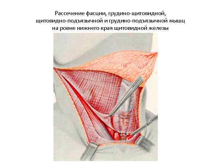 Рассечение фасции, грудино-щитовидной, щитовидно-подъязычной и грудино-подъязычной мышц на ровне нижнего края щитовидной железы 