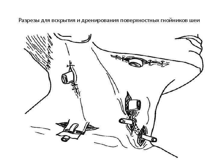 Разрезы для вскрытия и дренирования поверхностных гнойников шеи 