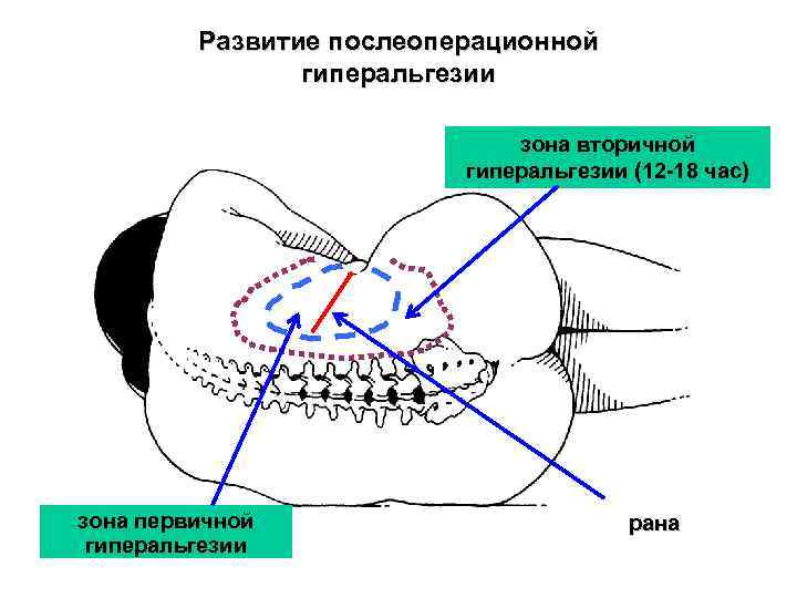 Развитие послеоперационной гиперальгезии зона вторичной гиперальгезии (12 -18 час) зона первичной гиперальгезии рана 