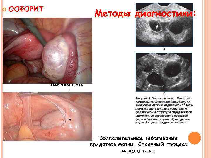  ООФОРИТ Методы диагностики: Воспалительные заболевания придатков матки. Спаечный процесс малого таза. 