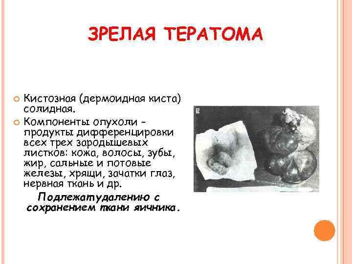 ЗРЕЛАЯ ТЕРАТОМА Кистозная (дермоидная киста) солидная. Компоненты опухоли продукты дифференцировки всех трех зародышевых листков: