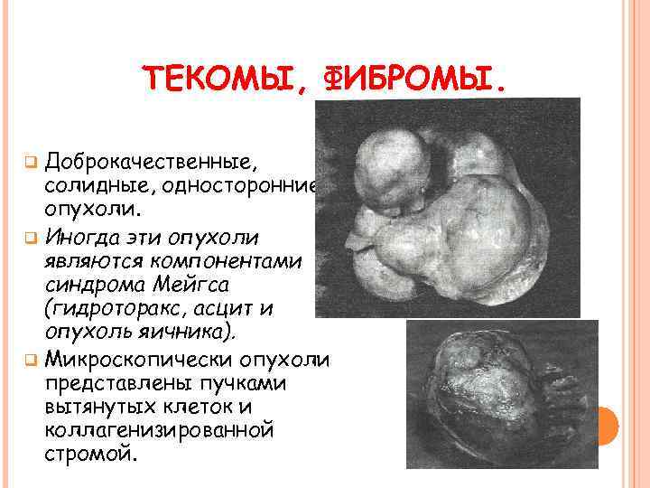 ТЕКОМЫ, ФИБРОМЫ. Доброкачественные, солидные, односторонние опухоли. q Иногда эти опухоли являются компонентами синдрома Мейгса