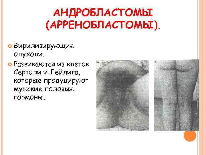 АНДРОБЛАСТОМЫ (АРРЕНОБЛАСТОМЫ). Вирилизирующие опухоли. Развиваются из клеток Сертоли и Лейдига, которые продуцируют мужские половые