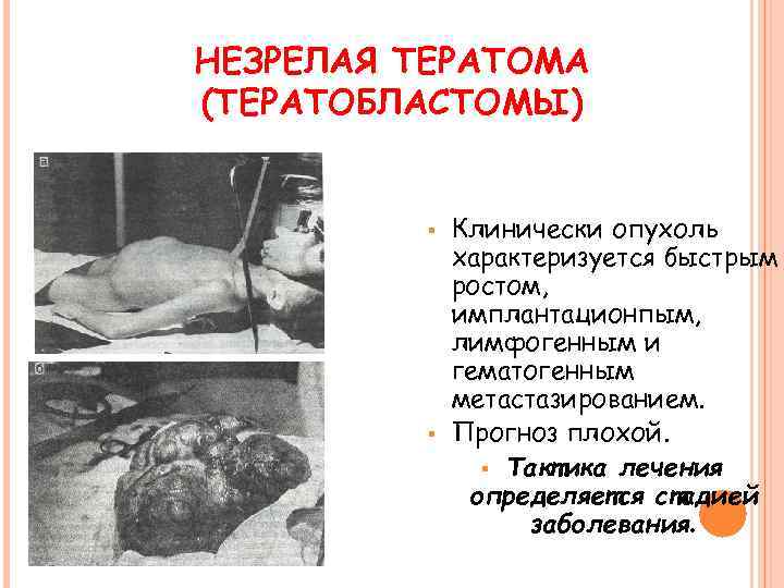 НЕЗРЕЛАЯ ТЕРАТОМА (ТЕРАТОБЛАСТОМЫ) § § Клинически опухоль характеризуется быстрым ростом, имплантационпым, лимфогенным и гематогенным