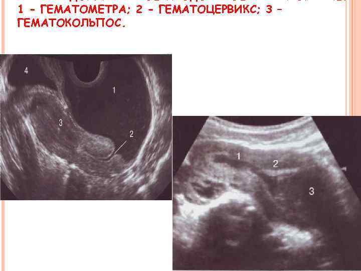 Гематометра что это такое. Гематокольпос и гематометра. Лохиометра и гематометра. Гематометра и беременность по УЗИ.