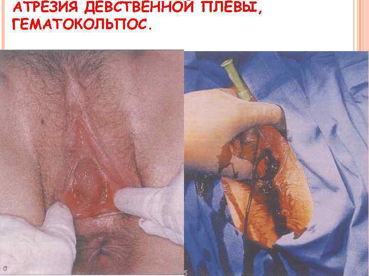 АТРЕЗИЯ ДЕВСТВЕННОЙ ПЛЕВЫ, ГЕМАТОКОЛЬПОС. 