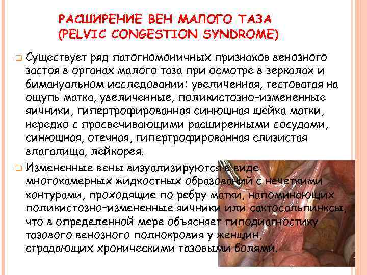 РАСШИРЕНИЕ ВЕН МАЛОГО ТАЗА (PELVIC CONGESTION SYNDROME) Существует ряд патогномоничных признаков венозного застоя в