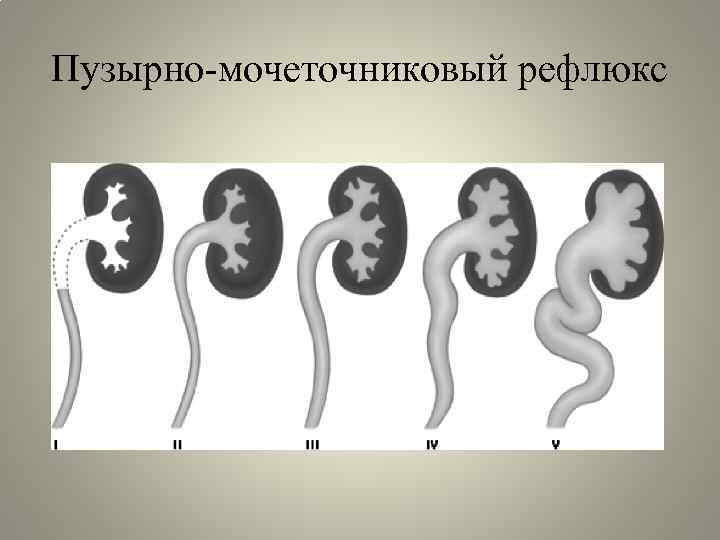 Пузырно мочеточниковый рефлюкс презентация