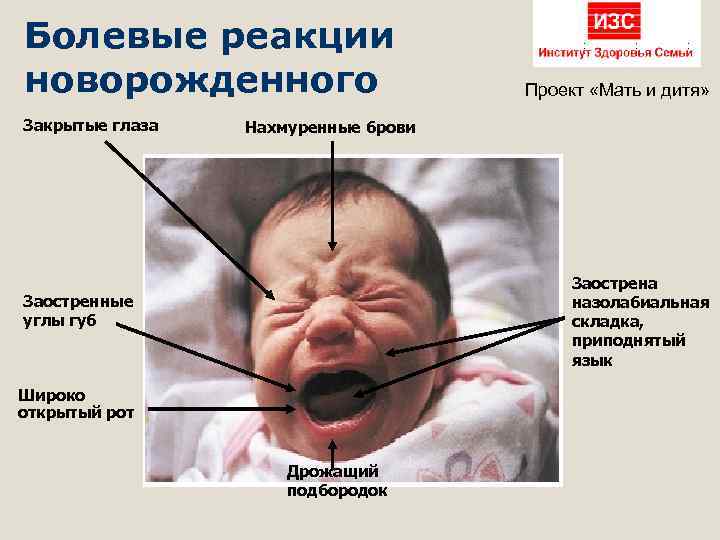 Болевые реакции новорожденного Закрытые глаза Проект «Мать и дитя» Нахмуренные брови Заострена назолабиальная складка,