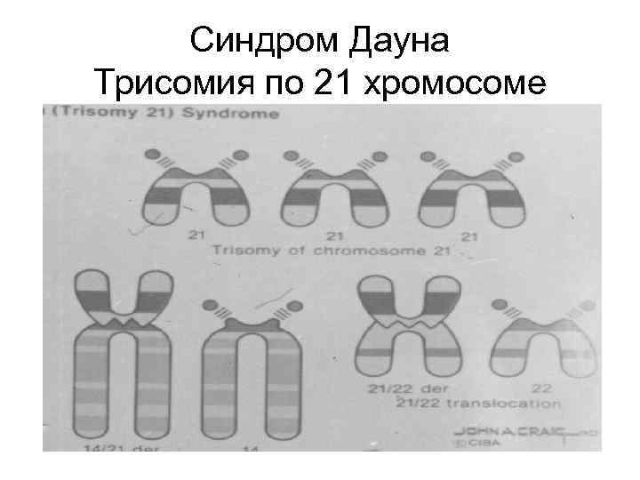 Синдром Дауна Трисомия по 21 хромосоме 