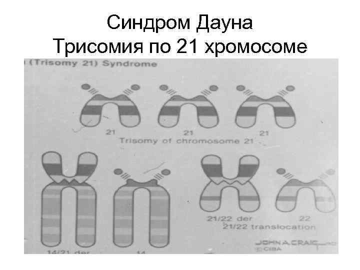 Трисомия по х хромосоме фото