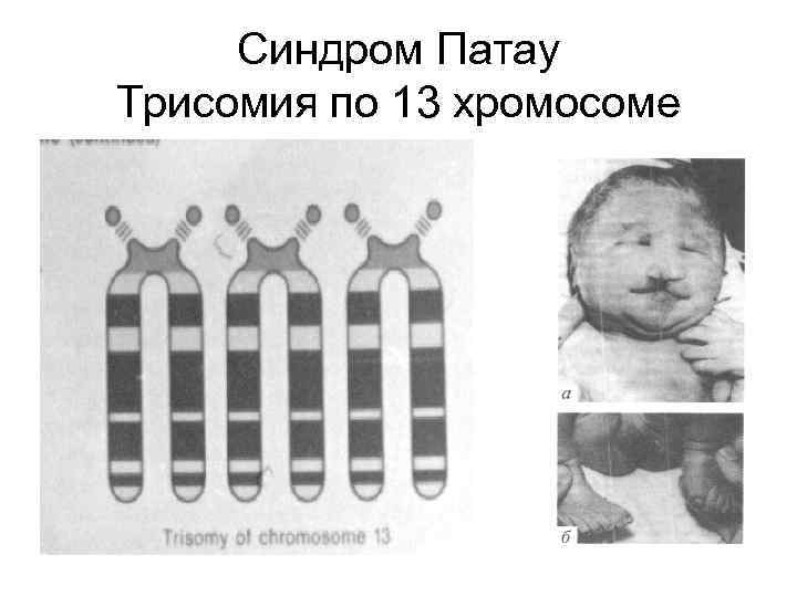 Синдром Патау Трисомия по 13 хромосоме 