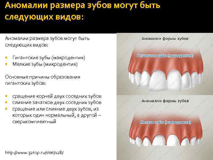 Аномалии Зубов Фото