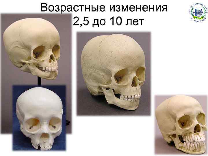 Меняется форма черепа. Возрастные изменения черепа человека. Изменение черепа с возрастом. Изменение черепа человека с возрастом.