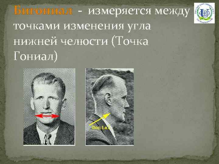 Бигониал - измеряется между точками изменения угла нижней челюсти (Точка Гониал) 