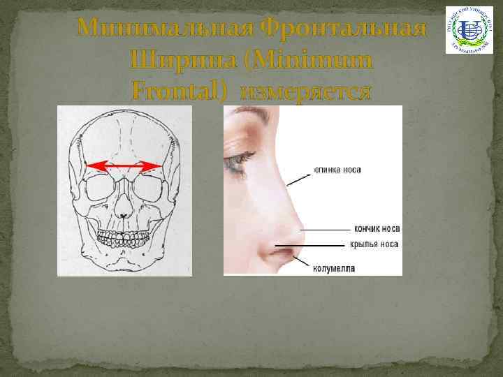 Минимальная Фронтальная Ширина (Minimum Frontal) измеряется 