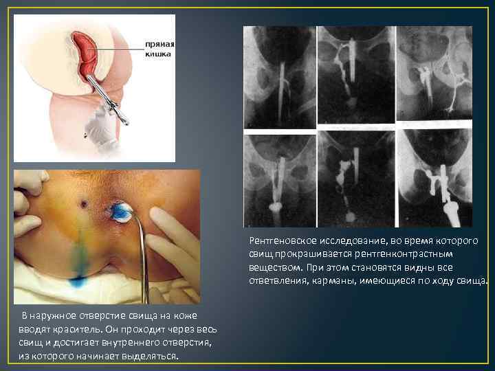 Рентгеновское исследование, во время которого свищ прокрашивается рентгенконтрастным веществом. При этом становятся видны все