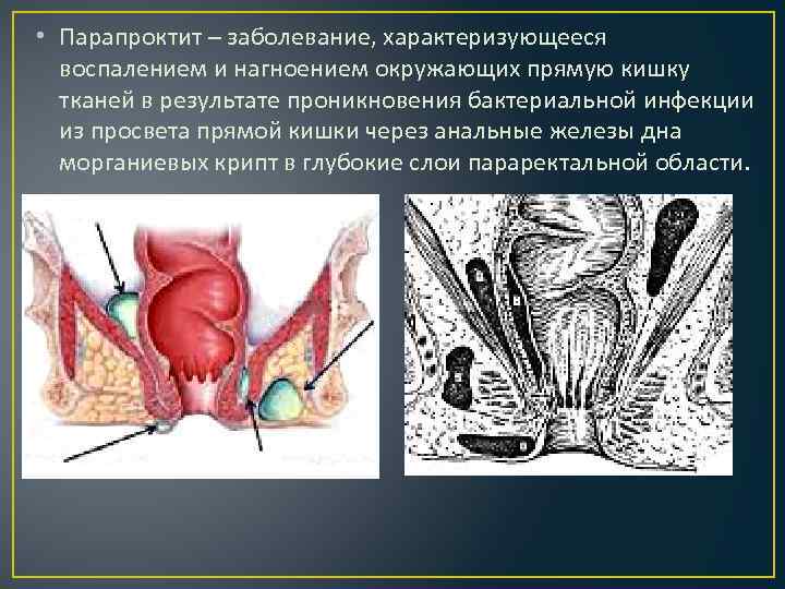  • Парапроктит – заболевание, характеризующееся воспалением и нагноением окружающих прямую кишку тканей в