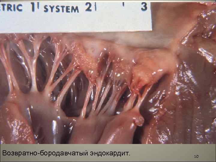 Возвратно-бородавчатый эндокардит. 10 