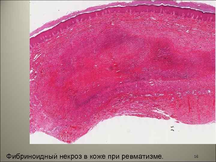 Фибриноидный некроз в коже при ревматизме. 16 