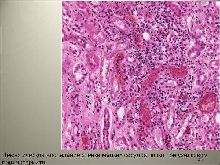 Некротическое воспаление стенки мелких сосудов почки при узелковом 24 периартериите. 