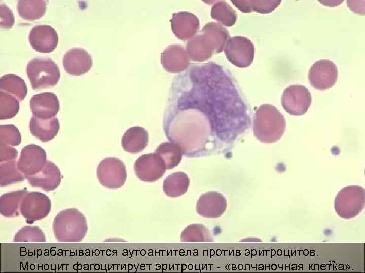 Вырабатываются аутоантитела против эритроцитов. 27 Моноцит фагоцитирует эритроцит - «волчаночная клетка» . 