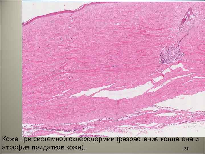 Кожа при системной склеродермии (разрастание коллагена и атрофия придатков кожи). 34 