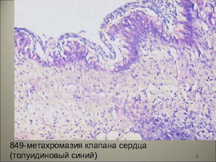 849 -метахромазия клапана сердца (толуидиновый синий) 5 