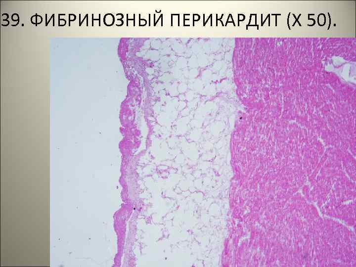 39. ФИБРИНОЗНЫЙ ПЕРИКАРДИТ (Х 50). 