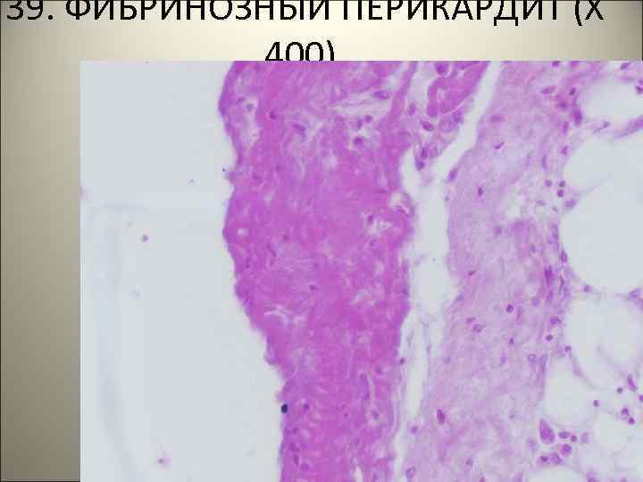 39. ФИБРИНОЗНЫЙ ПЕРИКАРДИТ (Х 400). 