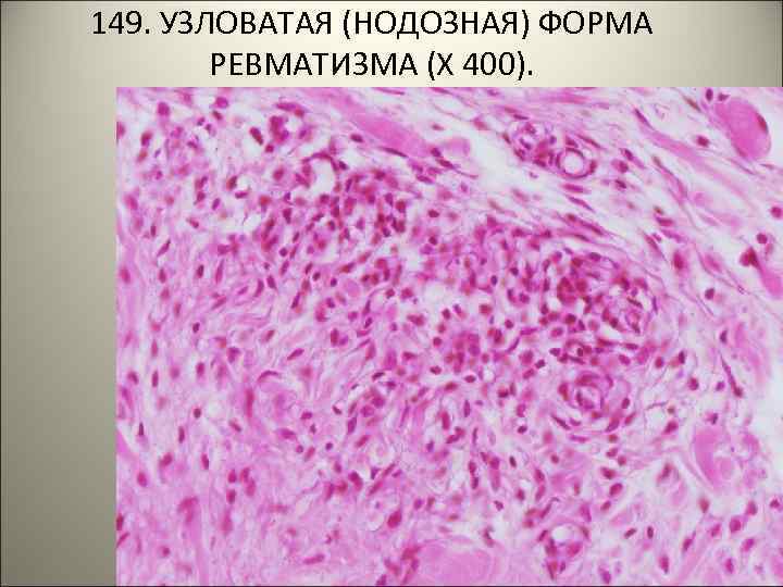 149. УЗЛОВАТАЯ (НОДОЗНАЯ) ФОРМА РЕВМАТИЗМА (Х 400). 